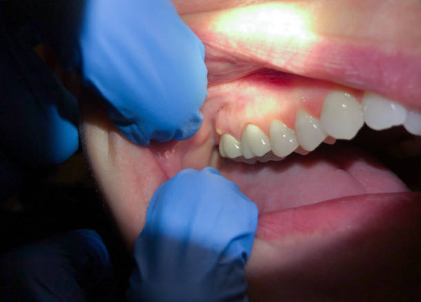 Best Emergency Dentist for Knocked-Out Tooth in Woodstown, NJ